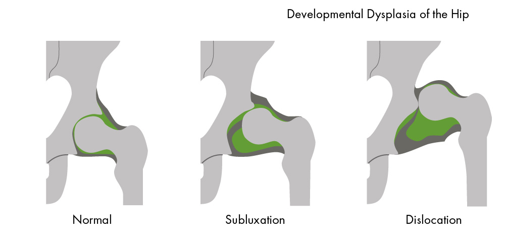 Image of Hip Dysplasia 